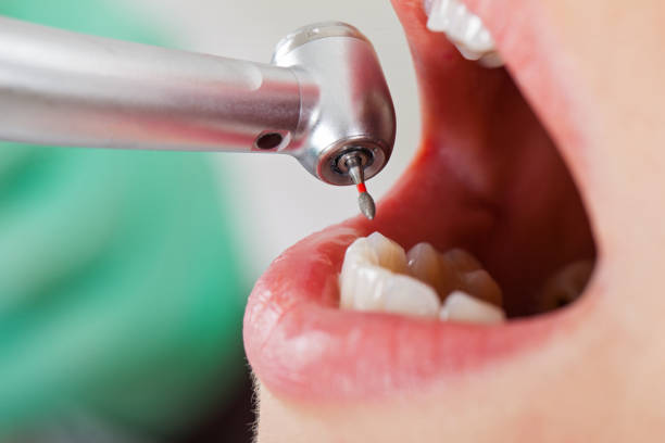 Best Emergency Tooth Extraction in Lubbock, TX